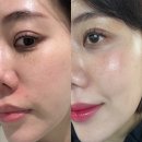 하이300 | 신논현피부과 덴서티 하이 300샷 모공 잔주름 피부결 개선 리프팅 후기