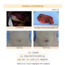 담낭용종수술후기. 담낭용종이 점차 커지다가 1cm 이상이 되어서 제거해야 할지, 수술을 하는 것이 좋은지 알아보게... 이미지