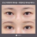 [성형외과 전문의 칼럼] 자연스럽게 눈이 커지고 싶다면? 뒤밑트임이 정답! (feat. 듀얼트임, 뒤밑트임...