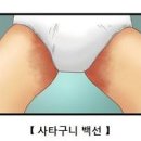 사타구니 가려움 백선 완선 두드러기 종기 원인 증상 치료 이미지
