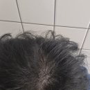 다모 | 다모케어정 피나스테리드 탈모약 부작용 후기