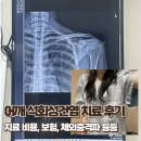 삼성건강약국 | 석회성건염 치료 후기｜20대 여자 체외충격파, 스테로이드, 물리치료, 어깨통증, 실비, 후기