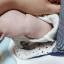 청도군보건소 | 청도 보건소 소아청소년과 진료 후기 아기 팔 멍울