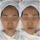 하주뷰티(HAJU Beauty) | 정자동피부관리ㅣ뷰티디안느 분당정자본점 페이스핏톡스 후기 이중턱 탄력관리