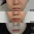 부천 중상동 유도짐 | 부천피부과, 팔자주름 콜라겐스킨부스터 올리디아 200% 만족한 후기(직후~1달)