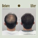 디비전 스칼프 | 평택두피문신 10년 이상의 경력 '디비전스칼프'