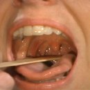 Cranial Nerve 검사 방법(04.10 교육 내용 中) - Cranial Nerves 9 &amp; 10- Sensory and Motor: Gag Reflex 이미지