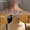 경찰병원역 4번출구(뒤) | 👰🏻‍♀️예비신부 필수! 제이윤 피부과 승모근 보톡스 리얼 후기