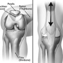 patella subluxation 4단계 구분. 이미지