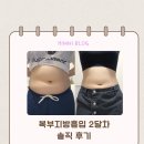 맵시나는 집 | 복부지방흡입출근 언제 가능할까? 옆구리지방흡입 2달차 솔직 후기