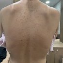 리유한의원 강남본점 등드름 미강약침 치료 가격 내돈내산 후기