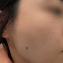 스킨25 - 영주시 | 대전여드름관리 잘하는 에스테틱 벨르스킨 압출 받은 후기