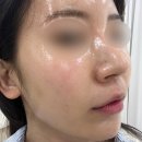 더히엘의원 | 압구정 피부과 오퍼스클리닉 리쥬란 통증 1도 없이 신부 관리 실화? 밀크필, 타켓쿨 시술