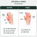 비바덤의원 | 비바덤의원 명절의 고질병 주부습진?
