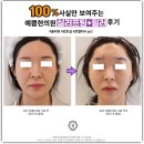 청주실리프팅 자연스럽게 잘하는곳 추천