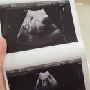 태동 | 32주 태동검사 후기 임산부 백일해주사 시기, 경산모도 또 맞아야 할까?