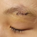 한솔외과의원 | 체리성형외과 어린이 봉합 가능 병원 주말 수술 후기