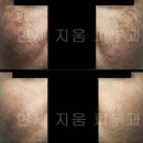 ★★★ IPL이나 레이저후 부작용으로 진해진 기미치료 : 연세지움피부과 ★★★ 이미지