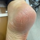 신기의료기 부산 남구점 | 부산 광안리 발각질제거 푸스케어 부산광안리W스퀘어점 부산 남구 아기발 된 솔직후기