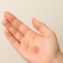 3 | 건선연고 광진구건선 사용후기 3