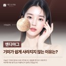 서울ND(엔디)의원 | 강동 엔디야그, 기미가 쉽게 사라지지 않는 이유는?