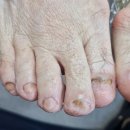 케어메디칼 | 두꺼운발톱, 내성무좀발톱 고민 해결! 메디컬풋케어 청주발관리 리얼 후기 | 청주문제성발톱, 파고드는발톱