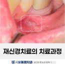 발치 진단 받은 치아의 재신경치료 과정 | 대구 수성구 서울동행치과의원