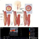 경동맥 협착증(CAROTID ARTERY STENOSIS) 이미지