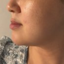 맑은얼굴피부과의원 | 선릉역피부과 슈덴하이리프팅 맑은선의원에서 받고 왔어요