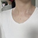 구림우리의원 | [화성,오산]편평사마귀 제거 후기 !