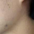 쉿 비밀이야 | 보톡스 ! 이마, 미간, 눈썹 그리고 턱 보턱스 쉿 빰빠한테는 비밀!! 보톡스 후기 통증 제오민 보톡스 후기