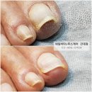 네일비타&푸스케어 건대점에서 남편 내성발톱 관리 후기!