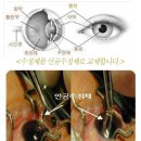 PART10. 감염과 백내장, 망막박리는 진정 무서운 것이다. 이미지