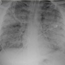급성호흡곤란증후군 원인과 증상 이미지