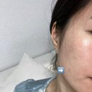 영주자인병원 | 💖자인 병원 피부과 쥬베룩 볼륨, 실펌레이저 후기💉