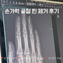 손가락골절 핀 제거 후기 및 비용 | 재활방법 | 회복기간