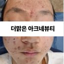 더맑은아크네뷰티