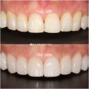워너비치과의원 | 50대 앞니 부분교정 4개월 + 무삭제라미네이트 젤라미 MTA 미니튜브 교정 사진 후기 기록