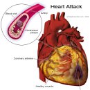 심근 경색증(Myocardial infarction) 이미지