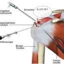 웰튼병원에선 어꺠회전근개파열 어깨 관절내시경 수술 6주 후 재활운동을 어떻게 하나요?!! 이미지