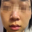서울더맑은피부과의원 | 숙대입구역피부과 기미잡티 색소치료 후기, 이 글로 종결합니다.