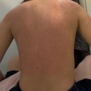 등드름 스트레스 분당한의원 등드름 치료후기 약초필링 등필링 ✨ 내돈내산