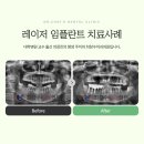 최창수외과의원 | 부산동구치과 레이저를 활용한 임플란트 후기
