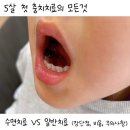 5살 아기 유아 충치 어린이치과 수면치료 일반치료 비교 후기