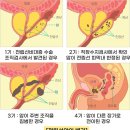 전립선 암 에 관하여 /서울 아산 병원 비뇨의학과 서준교 교수님 편 이미지