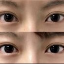파고다사진실 | 강남역 원더풀성형외과 눈 재수술 상담 후기