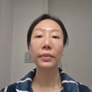 황수란피부과의원 | 피부과 이야기#2| 40대 피부과 탄력 시술 조합 후기,울쎄라피프라임,써마지,에스테필,리쥬란힐러