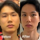 란다자리 | 압구정역 성형외과 남자눈성형 자연유착 눈매교정 후기 신랑 웨딩준비