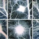 자폐증에 유난히 높은 간질발작과 Mast Cells (마스트세포)의 과활성화의 연관성 이미지