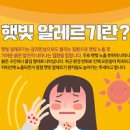 햇빛 알레르기 증상 약 연고 치료 방법 예방 이미지